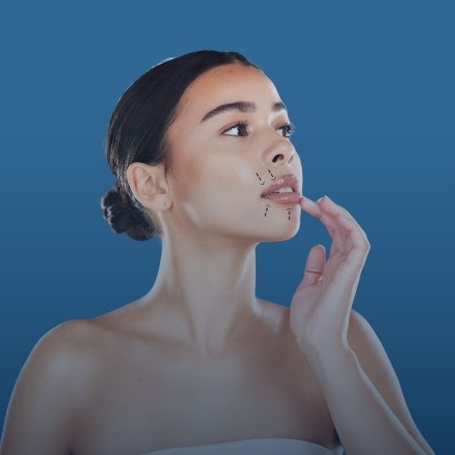 Lip Lift