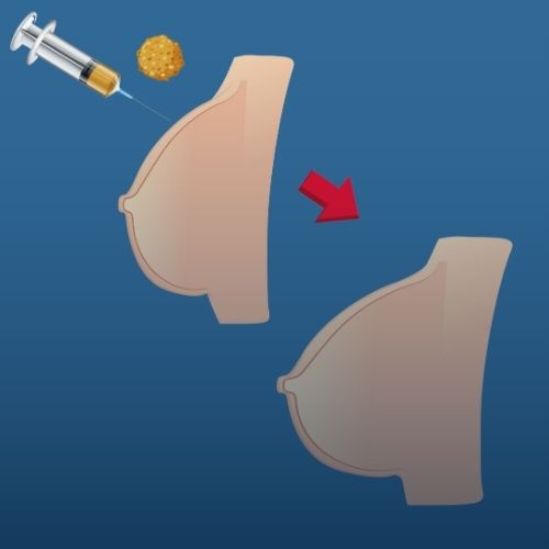 Meme Büyütme Yağ Enjeksiyonu İle