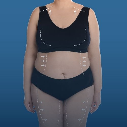 Post-Bariatrik Cerrahi (Body Lift)